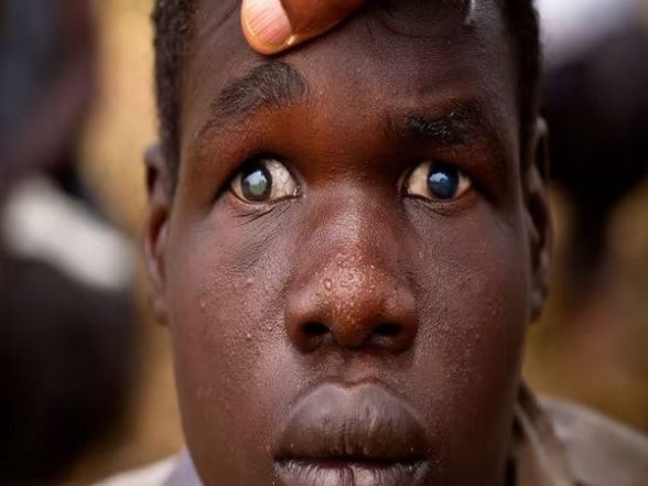 Health News | Scientists Reveal Retinal Cell Mapping Could Promote Accurate Therapies for Blindness - Vimarsana News