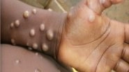 Monkeypox Outbreak: WHO Says &lsquo;Emergency Nature of Monkeypox Requires Intense Response Efforts&rsquo;