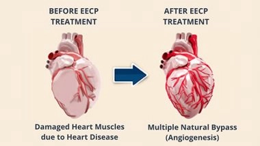 Business News | Know Why EECP is an Alternative to Bypass Surgery