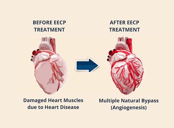 Business News | Know Why EECP is an Alternative to Bypass Surgery
