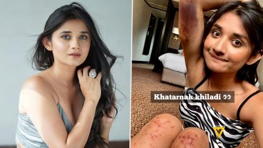 Khatron Ke Khiladi 12: Kanika Mann Suffers Injuries; Actress’ Bruised Picture Goes Viral