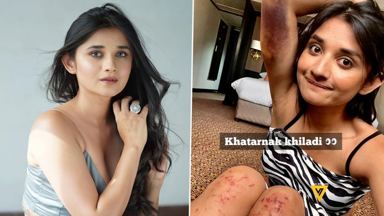 Khatron Ke Khiladi 12: Kanika Mann Suffers Injuries; Actress’ Bruised Picture Goes Viral