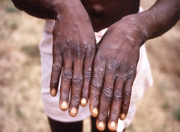 World News | More Than 550 Confirmed Monkeypox Cases Reported: UN