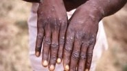 World News | Monkeypox Cases in Britain Surpass 500