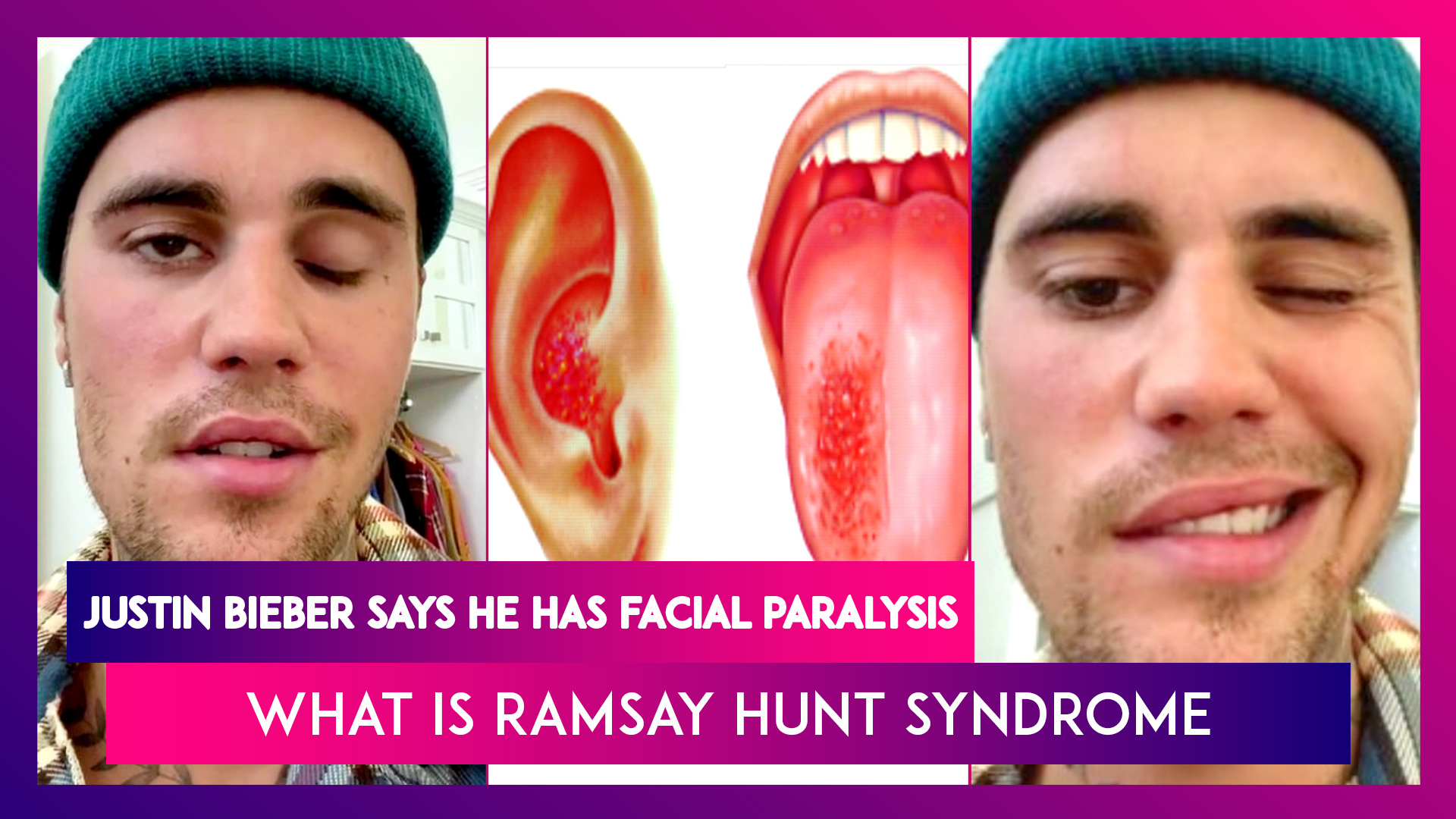 Justin Bieber Reveals He Has Facial Paralysis Caused by Ramsay Hunt Syndrome
