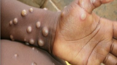 Monkeypox in India: Child Admitted to Andhra Pradesh’s GGH Hospital With MPV Virus Symptoms, Samples Sent to Pune for Testing