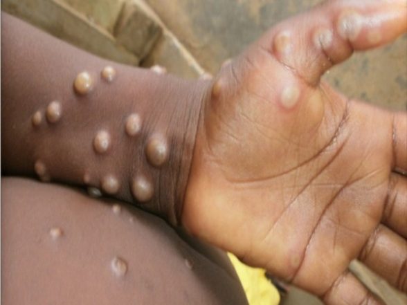 India News | Five-year-old Girl in UP's Ghaziabad with Suspected Monkeypox Infection Tests Negative - Vimarsana News