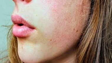 Lifestyle News | Research Finds Mites Live on Skin of Human's Face and Mate at Night