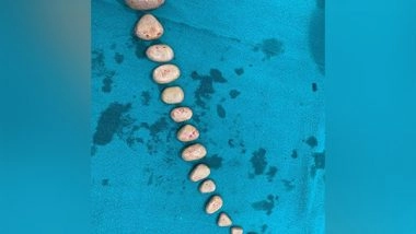 India News | Doctors Remove 16 Stones Weighing 500 Gms from Paralyzed Man's Bladder in Delhi Hospital