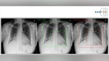 Business News | Enlarged Heart, Pulmonary Edema and Fluid in the ...