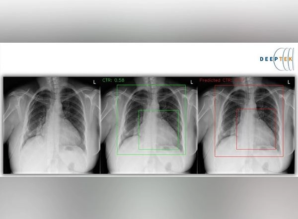 Business News | Enlarged Heart, Pulmonary Edema and Fluid in the Pleural Space Could Indicate Signs of an Underlying Heart Issue, Can Be Screened by DeepTek's Path Breaking Innovative Machine Learning Technique for Digital Chest X-rays