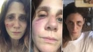 Judith Chemla Reveals Her Horrifying Story of Suffering Domestic Abuse, French Actress Shares Pics of Her Injuries on Instagram
