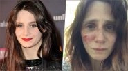 French Actress Judith Chemla Shares Horrific Photos of Injuries Stemming From Domestic Abuse