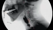 Science News | Research Shows New Guidelines Set to Standardize Swallowing Fluoroscopy
