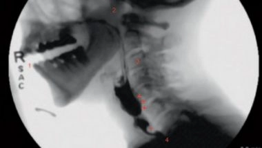 Science News | Research Shows New Guidelines Set to Standardize Swallowing Fluoroscopy