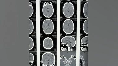 Health News | Study: Cells That Results in Neuronal Death in a Mouse Model of Mitochondrial Disease