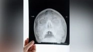 Science News | Surgery Can Be Avoided for Children with Rare Skull Tumor: Study