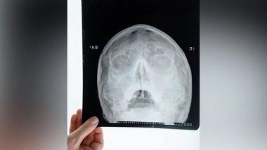 Science News | Surgery Can Be Avoided for Children with Rare Skull Tumor: Study