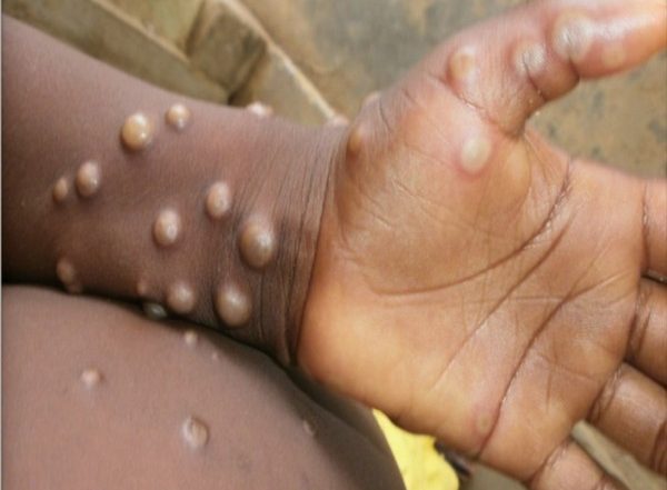 Singapore Confirms First Local Case of Monkeypox