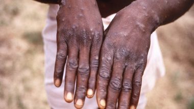 World News | Canada Confirms 278 Cases of Monkeypox