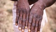 India News | India Reports Second Confirmed Monkeypox Case from Kerala