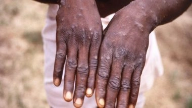 India News | Monkeypox Infectivity Less, but Can Be Fatal for Children: Expert