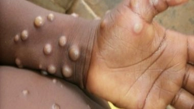 India News | Health Ministry Issues Guidelines for the Management of Monkeypox