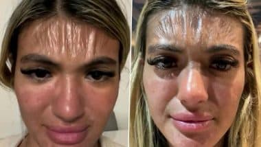 UK Beautician Sirin Murad Forehead Looks Like 'Plastic' After Sleeping Under the Sun For 30 Mins, See Pics Behind Viral Claim