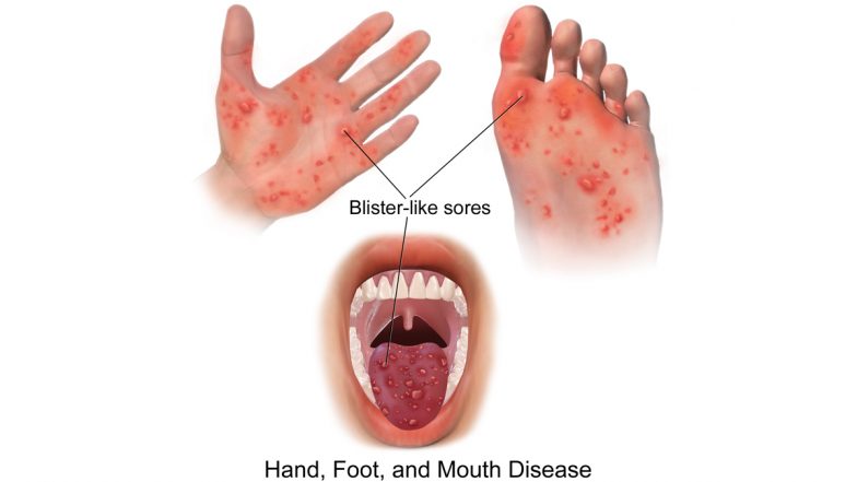 Tomato Flu: Centre Issues Advisory on Hand, Foot and Mouth Disease; Know Symptoms and Precautions to Take to Prevent HFMD