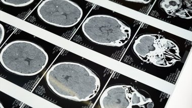 Health News | New Injectable Gel Holds Promise for Tough-to-treat Brain Tumours