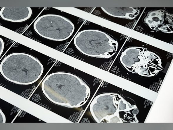 Health News | New Injectable Gel Holds Promise for Tough-to-treat Brain Tumours - Vimarsana News