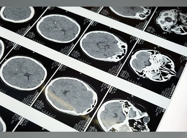 Health News | New Injectable Gel Holds Promise for Tough-to-treat Brain Tumours