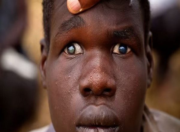 Health News | Researchers Discover New Diagnostic Method for Posterior Uveitis Eye Disease