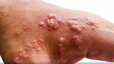 Monkeypox Virus Can Persist in Semen for Weeks After Recovery: Lancet