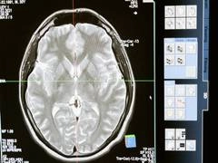 Health News | Do You Know Particular Brain Reactions to Traumatic Stress Are Associated with PTSD Risk?