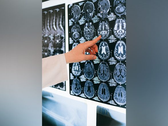 Health News | AI Algorithm That Recognizes Anomalies in Brain May Help Treat Epilepsy - Vimarsana News