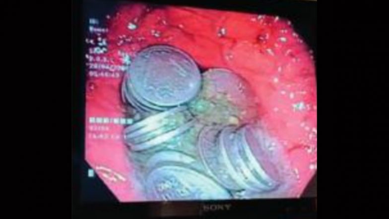 Rajasthan: 63 Coins Removed From 36-Year-Old Man’s Stomach in Jodhpur