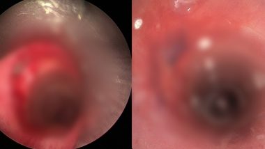 Uttar Pradesh: SGPGIMS Doctors Perform Rare Bronchoscopic Removal of Bullet in Lucknow