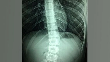 Health News | Researchers Find Epigenetic Treatment Can Aid Regrowth of Sensory, Motor Neurons in Spinal Cord