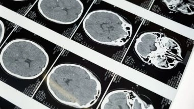 Health News | What Happens in Brain when It Becomes Too Hot?