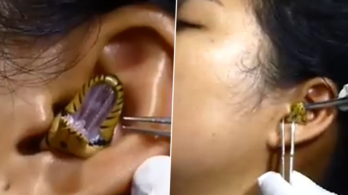 OMG! Snake Gets Trapped in Woman's Ear Hole; Doctor Tries to Pull Out The Reptile With Tongs in Viral Video | ? LatestLY