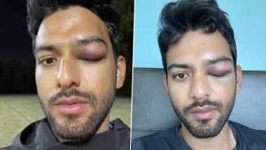 Unmukt Chand, Former India U19 Captain, Suffers Gruesome Eye Injury