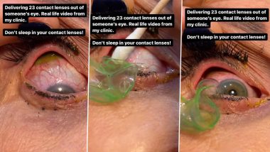 Video: Bizarre! Doctor Removes 23 Contact Lenses From Woman’s Eye