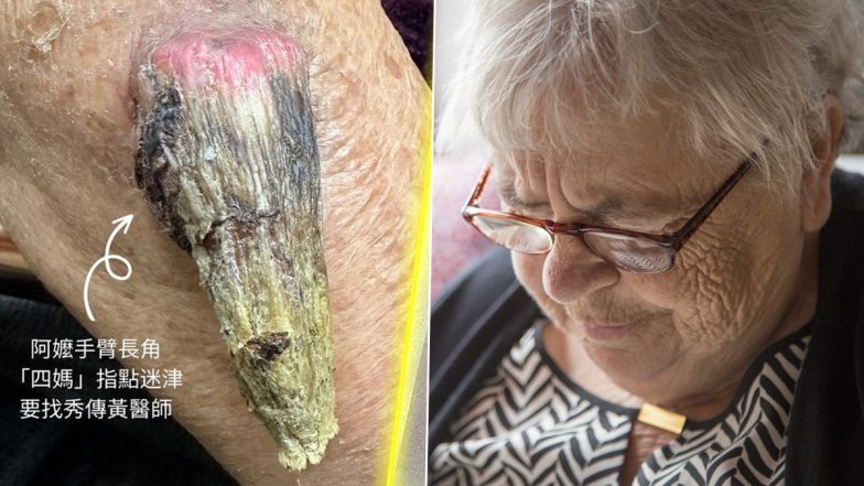 Strange! Rare 'Fairy' Horn Grows on Grandmother's Arm in Taiwan; The Appendage Measures 7 Centimetres Long!