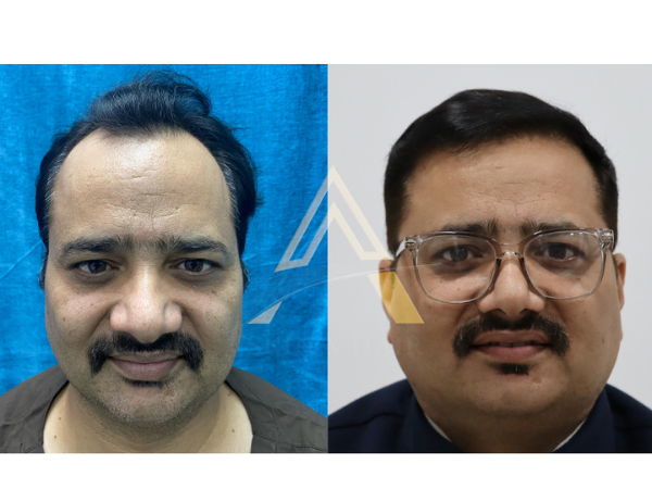 Business News | Dr Alok Sahoo, MD (AIIMS) to Launch a New Hair Transplant  Clinic in Bhubaneswar | LatestLY