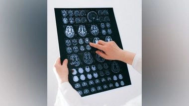 Health News | Study Suggests How MRI Shows Brain Changes in Patina Post-COVID