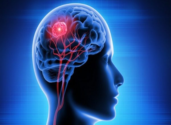 Health News | Study: High-resolution MRI Shows Brain Changes in People with Migraine