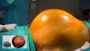 Hyderabad: Football-Sized Kidney Tumour Weighing 10 Kg Removed by Doctors To Save Patient&rsquo;s Life (See Pics)