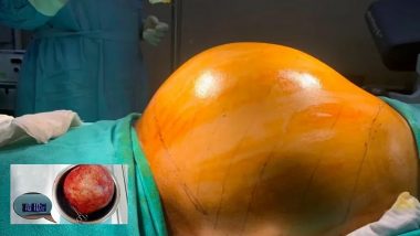 Hyderabad: Football-Sized Kidney Tumour Weighing 10 Kg Removed by Doctors To Save Patient’s Life (See Pics)