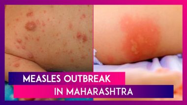 Measles Outbreak In Maharashtra: 538 Confirmed Cases Reported In The State; Mumbai, Malegaon & Bhiwandi Witness Slight Increase In Number